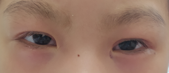 周太平醫生上瞼下垂矯正效果