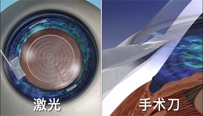 白內障手術(shù)