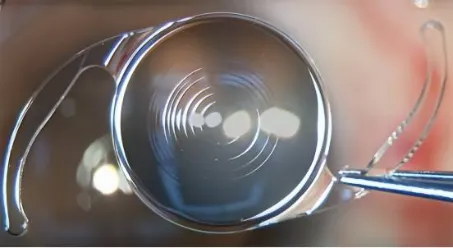 白內障多焦點(diǎn)人工晶體